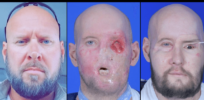 Will eye and face transplants become more common? First recipient is making a strong recovery